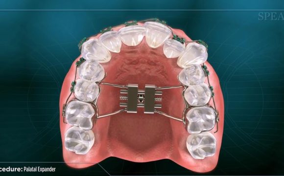 Palatal Expander